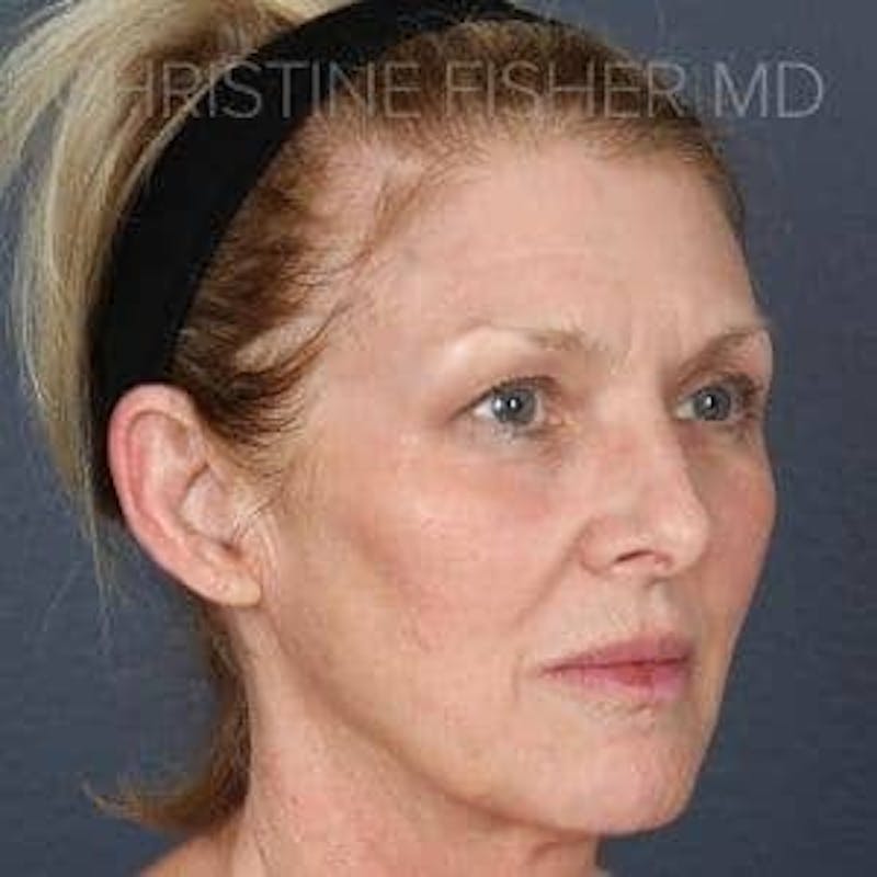 Collagen & Dermal Fillers Before & After Gallery - Patient 314467 - Image 4