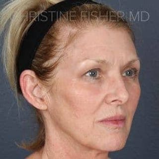 Collagen & Dermal Fillers Before & After Gallery - Patient 314467 - Image 4