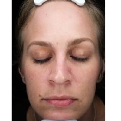 Microneedling Before & After Gallery - Patient 181790 - Image 2
