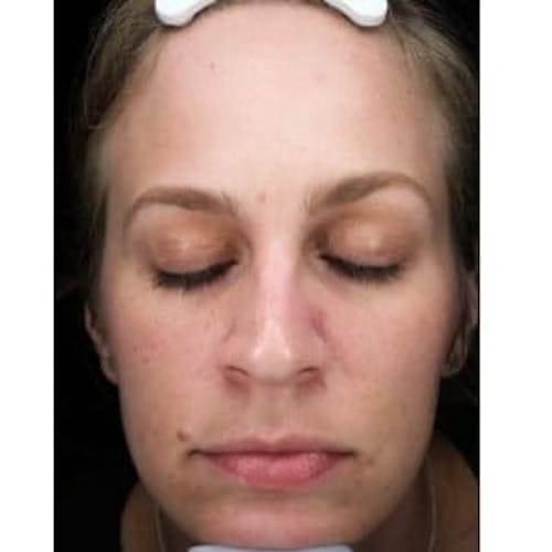 After procedure image for Microneedling
