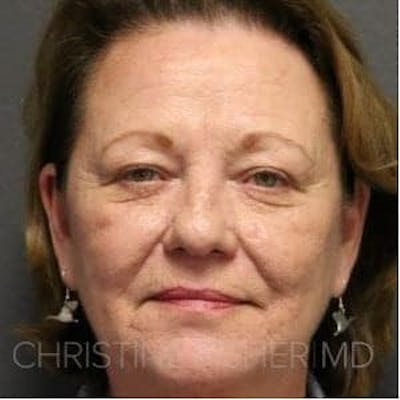 Liquid Facelift Before & After Gallery - Patient 127849 - Image 1