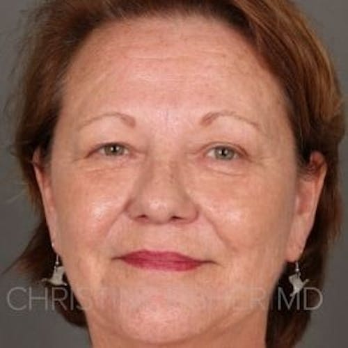 After procedure image for Liquid Facelift