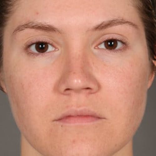 Before procedure image for Microneedling