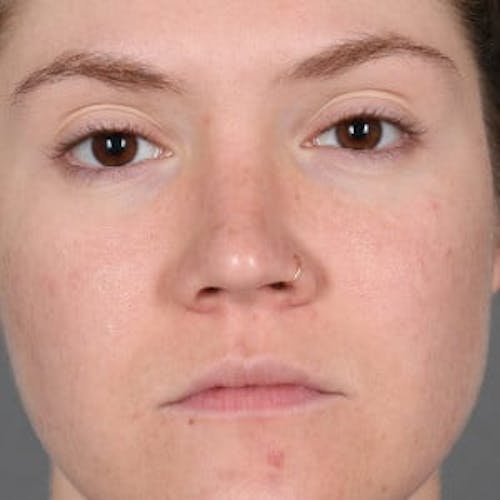 After procedure image for Microneedling