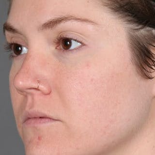Microneedling Before & After Gallery - Patient 375890 - Image 4
