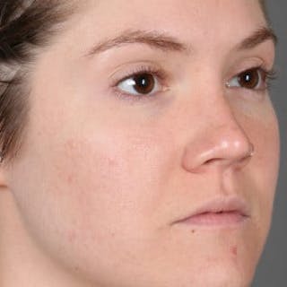 Microneedling Before & After Gallery - Patient 375890 - Image 6