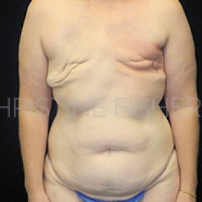 DIEP Flap Before & After Gallery - Patient 254389 - Image 1