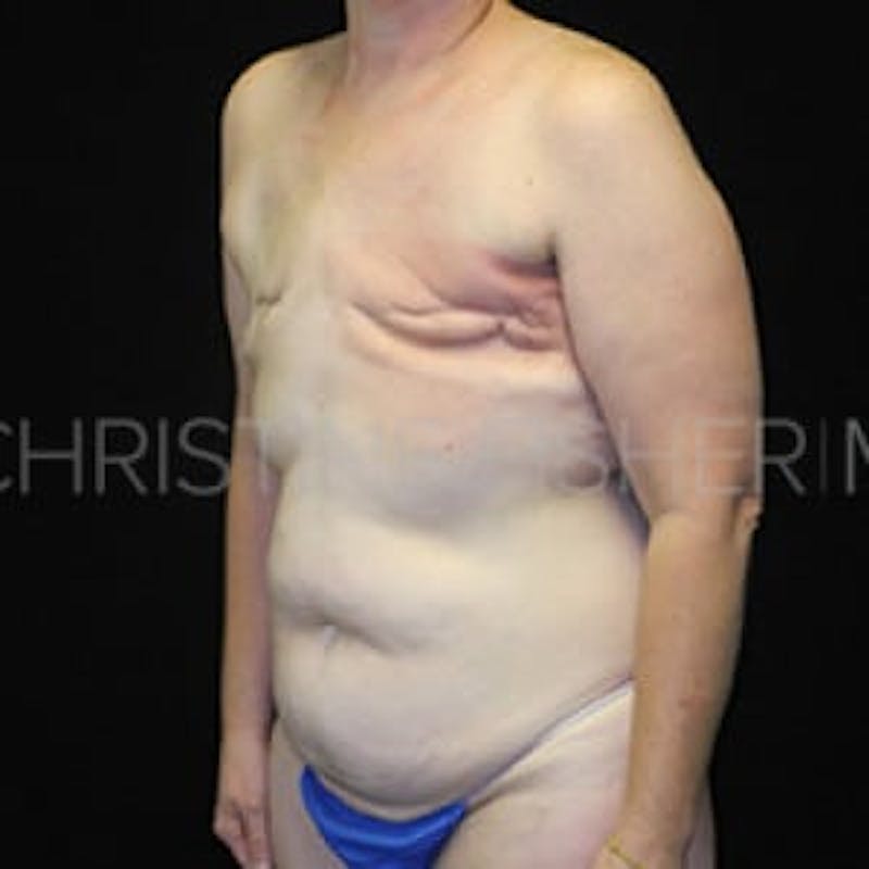 Areola Tattooing Before & After Gallery - Patient 200849 - Image 3