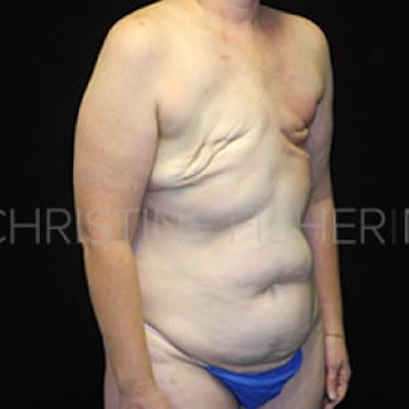 Areola Tattooing Before & After Gallery - Patient 200849 - Image 5