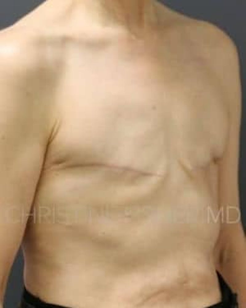 Areola Tattooing Before & After Gallery - Patient 237931 - Image 3