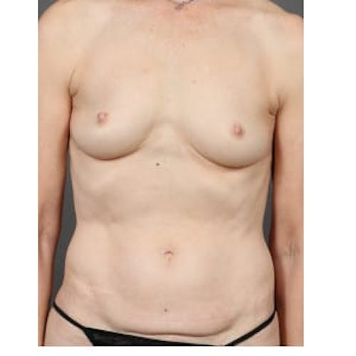 Before procedure image for Hybrid Breast Reconstruction