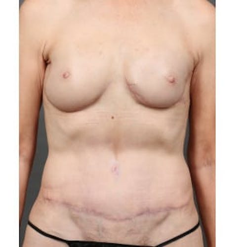 After procedure image for Hybrid Breast Reconstruction