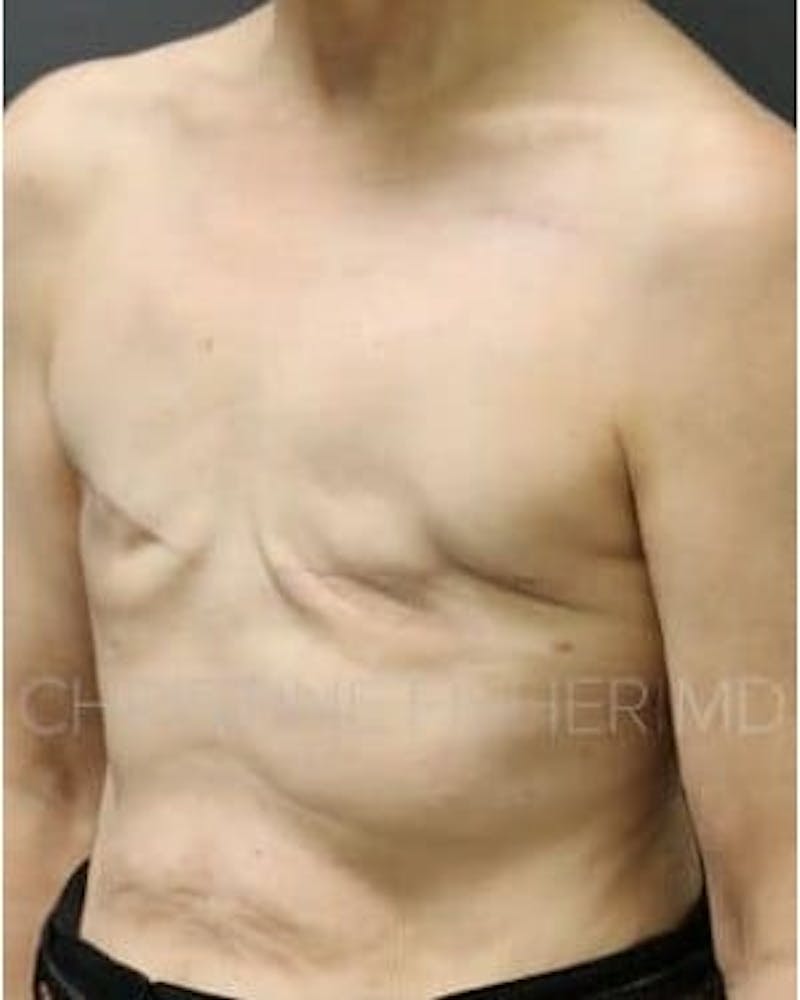 Areola Tattooing Before & After Gallery - Patient 237931 - Image 5