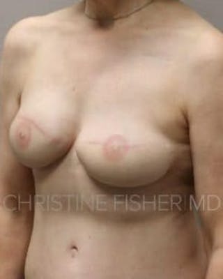 Areola Tattooing Before & After Gallery - Patient 237931 - Image 6