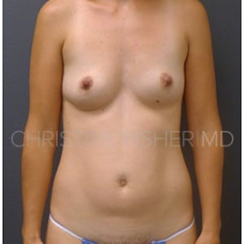 Nipple-Sparing Breast Reconstruction Before & After Gallery - Patient 248175 - Image 1
