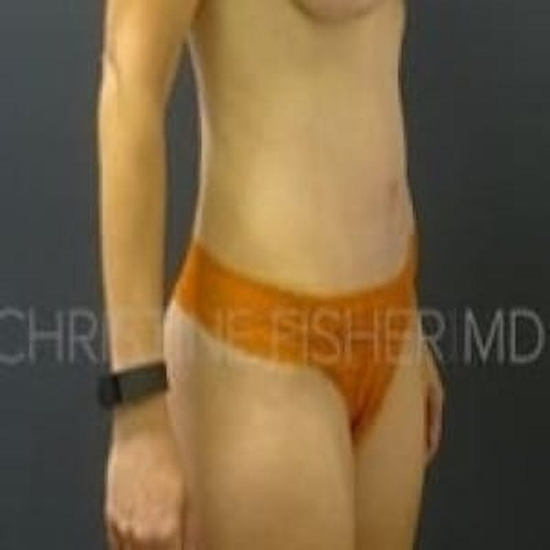 Abdominoplasty / Tummy Tuck Before & After Gallery - Patient 288438 - Image 4