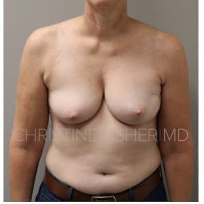 Nipple-Sparing Breast Reconstruction Before & After Gallery - Patient 885899 - Image 1