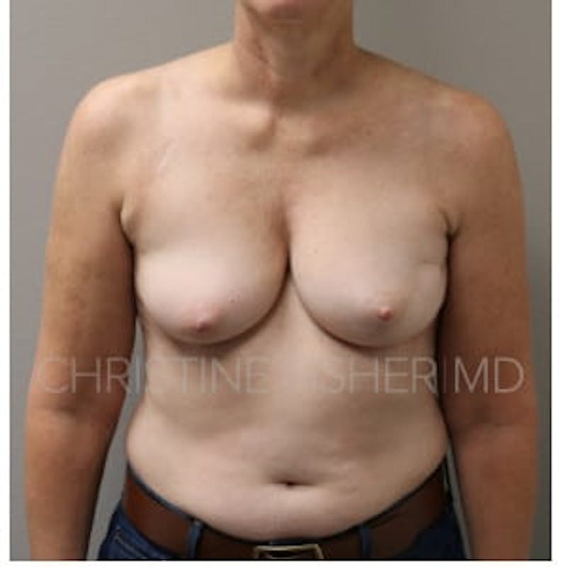 Nipple-Sparing Breast Reconstruction Before & After Gallery - Patient 885899 - Image 1