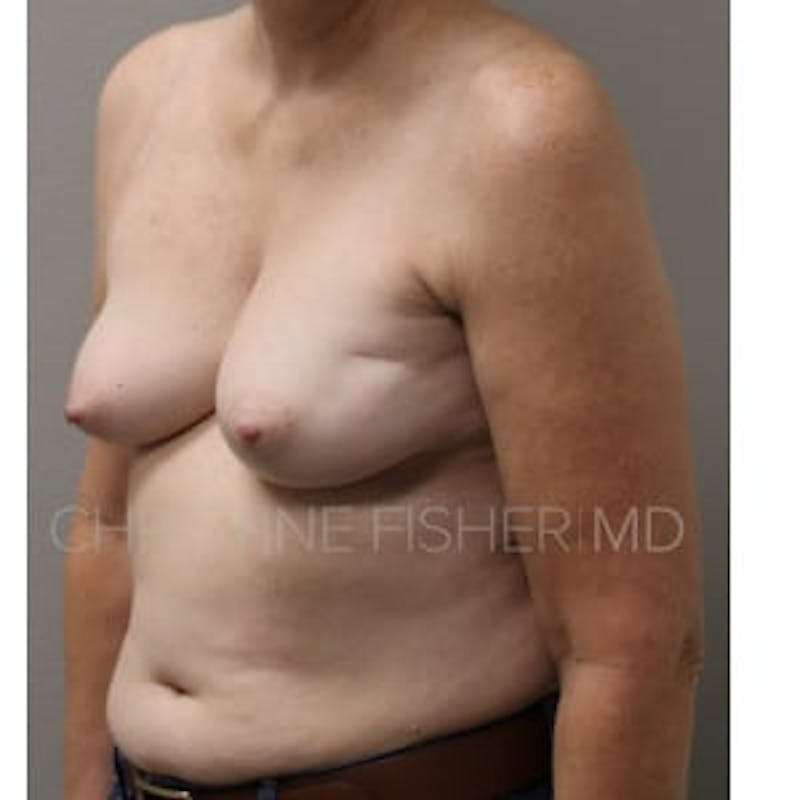 Nipple-Sparing Breast Reconstruction Before & After Gallery - Patient 885899 - Image 3