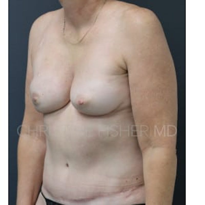 Nipple-Sparing Breast Reconstruction Before & After Gallery - Patient 885899 - Image 4