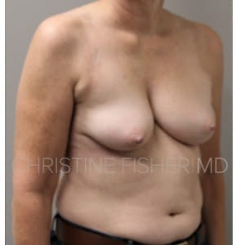 Nipple-Sparing Breast Reconstruction Before & After Gallery - Patient 885899 - Image 5