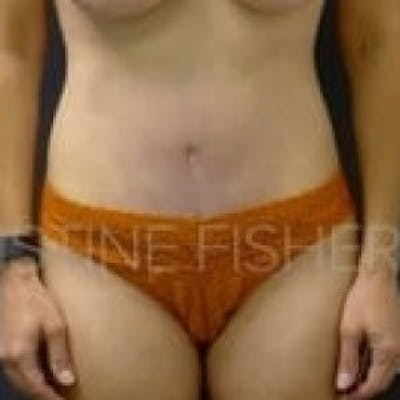 Liposuction Before & After Gallery - Patient 311432 - Image 2