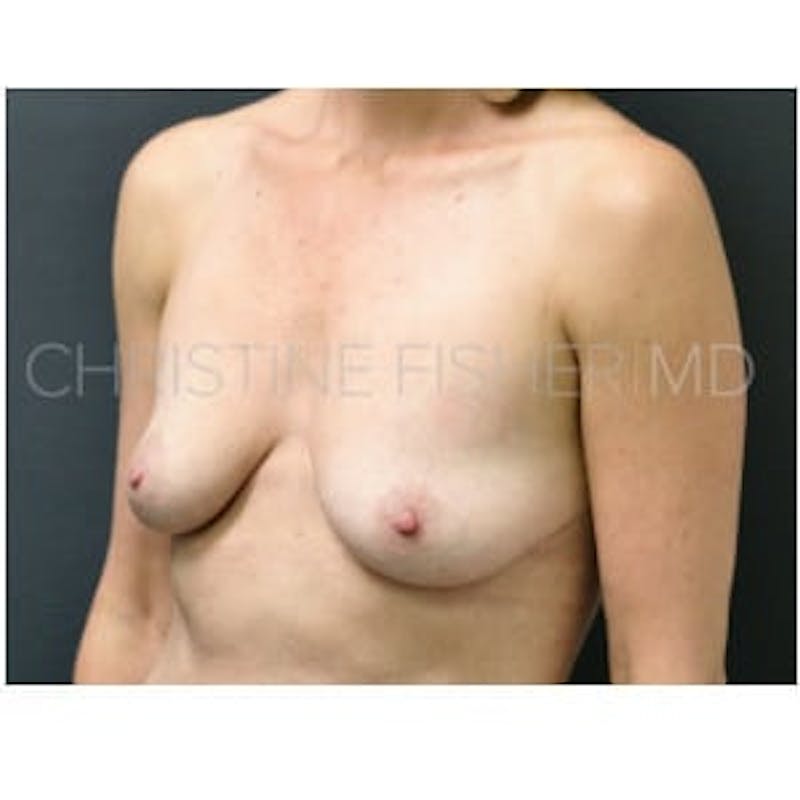 Implant Breast Reconstruction Before & After Gallery - Patient 528821 - Image 3