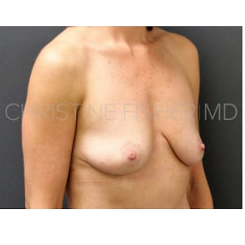 Implant Breast Reconstruction Before & After Gallery - Patient 528821 - Image 5