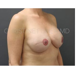 Implant Breast Reconstruction Before & After Gallery - Patient 528821 - Image 6