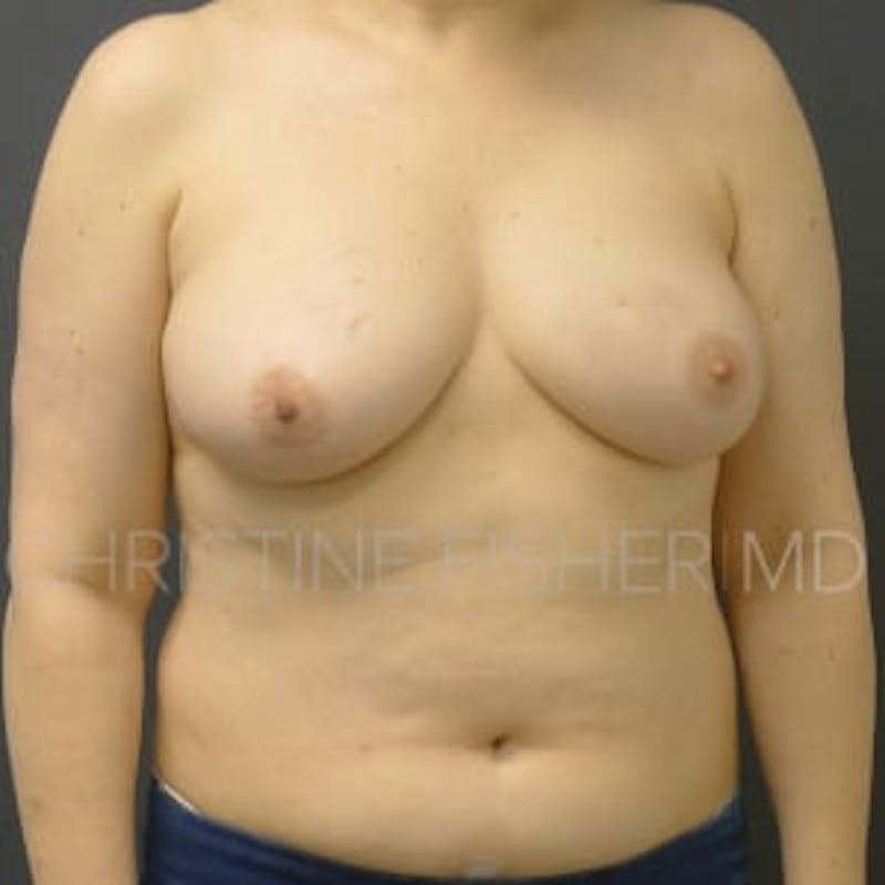 Nipple-Sparing Breast Reconstruction Before & After Gallery - Patient 423010 - Image 1