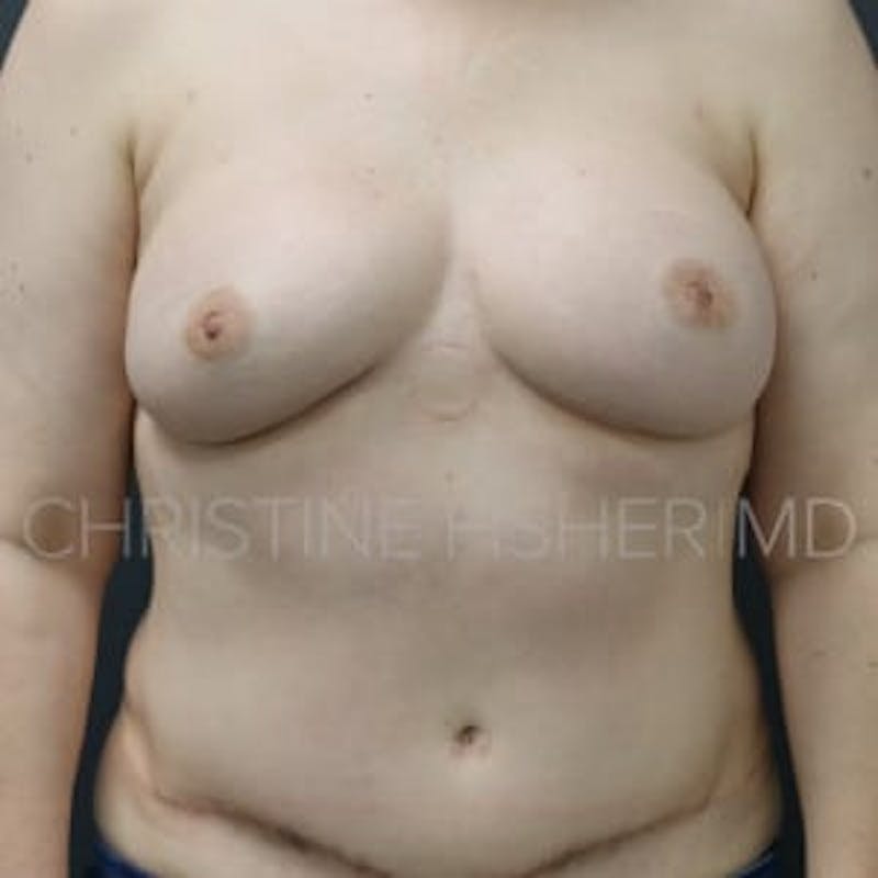 Nipple-Sparing Breast Reconstruction Before & After Gallery - Patient 423010 - Image 2