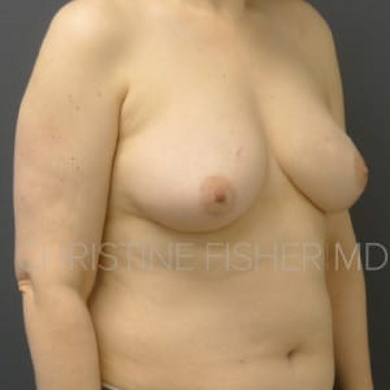 Nipple-Sparing Breast Reconstruction Before & After Gallery - Patient 423010 - Image 5