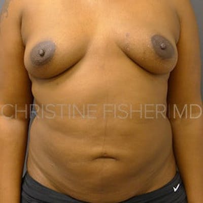 Implant Breast Reconstruction Before & After Gallery - Patient 205172 - Image 1