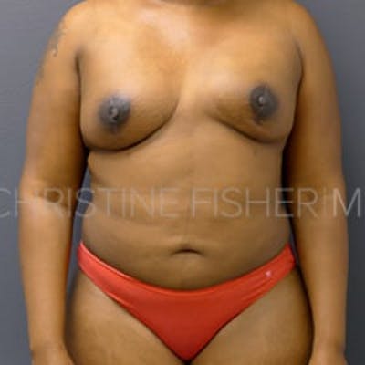 Implant Breast Reconstruction Before & After Gallery - Patient 205172 - Image 2