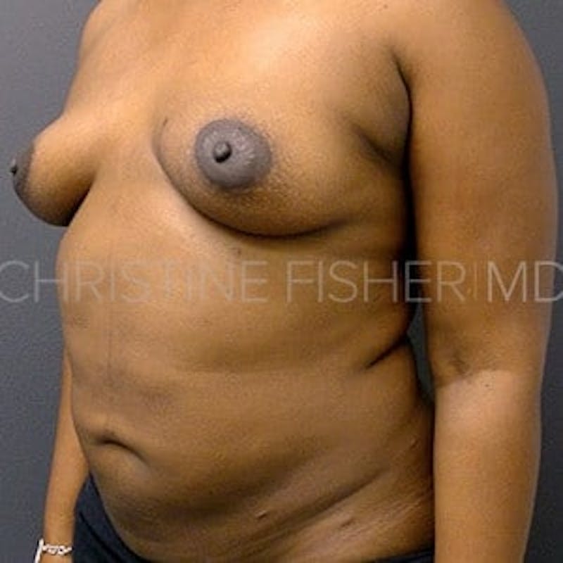 Implant Breast Reconstruction Before & After Gallery - Patient 205172 - Image 3