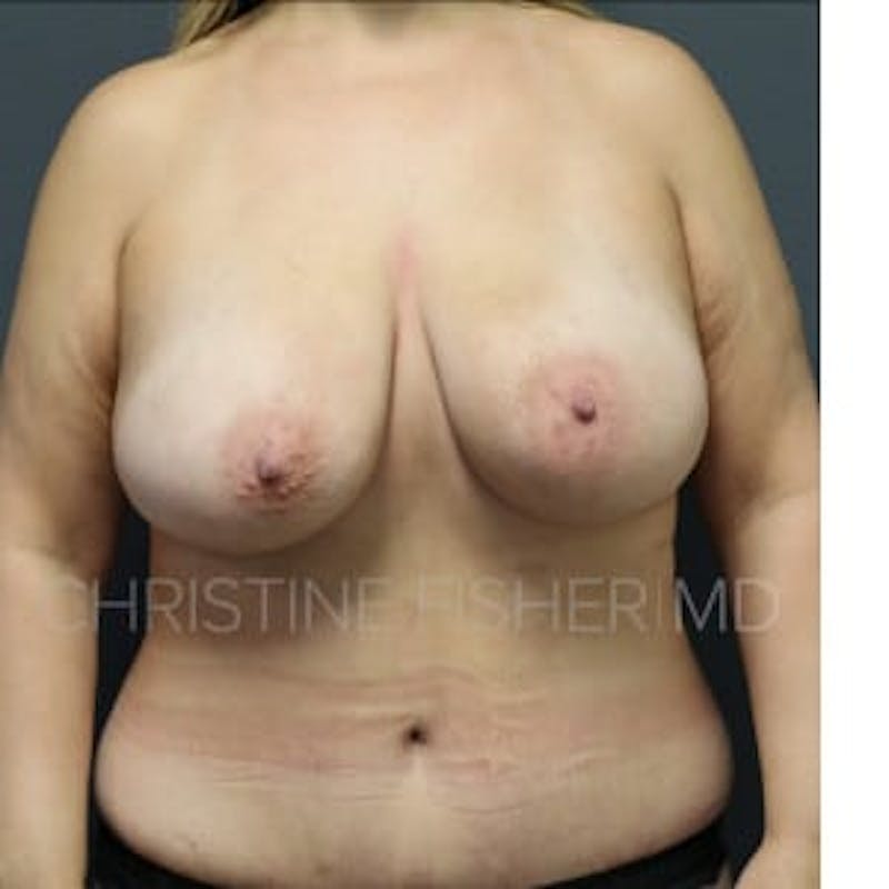 Nipple-Sparing Breast Reconstruction Before & After Gallery - Patient 239685 - Image 2