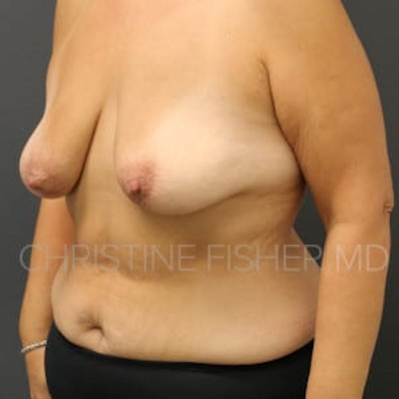 Nipple-Sparing Breast Reconstruction Before & After Gallery - Patient 239685 - Image 3