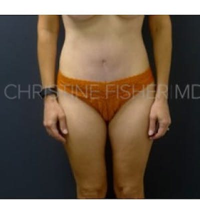 Abdominoplasty / Tummy Tuck Before & After Gallery - Patient 114021 - Image 2