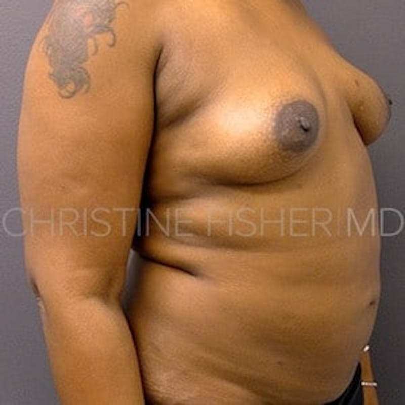 Implant Breast Reconstruction Before & After Gallery - Patient 205172 - Image 5