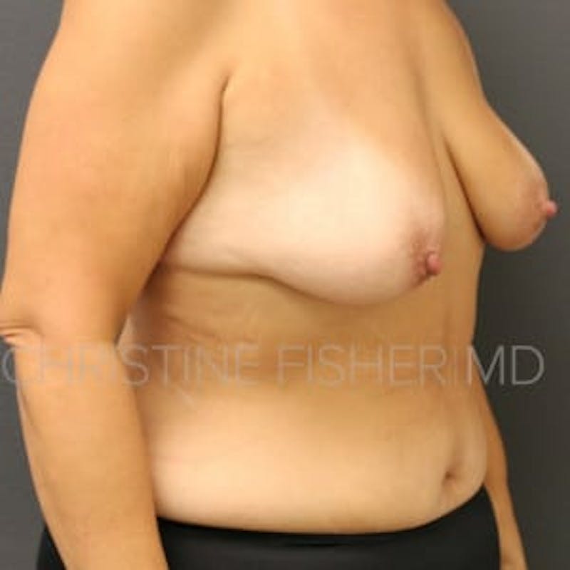 Nipple-Sparing Breast Reconstruction Before & After Gallery - Patient 239685 - Image 5