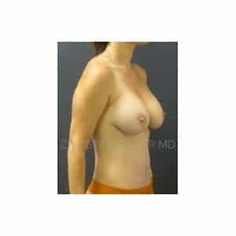 Mommy Makeover Before & After Gallery - Patient 214334 - Image 6