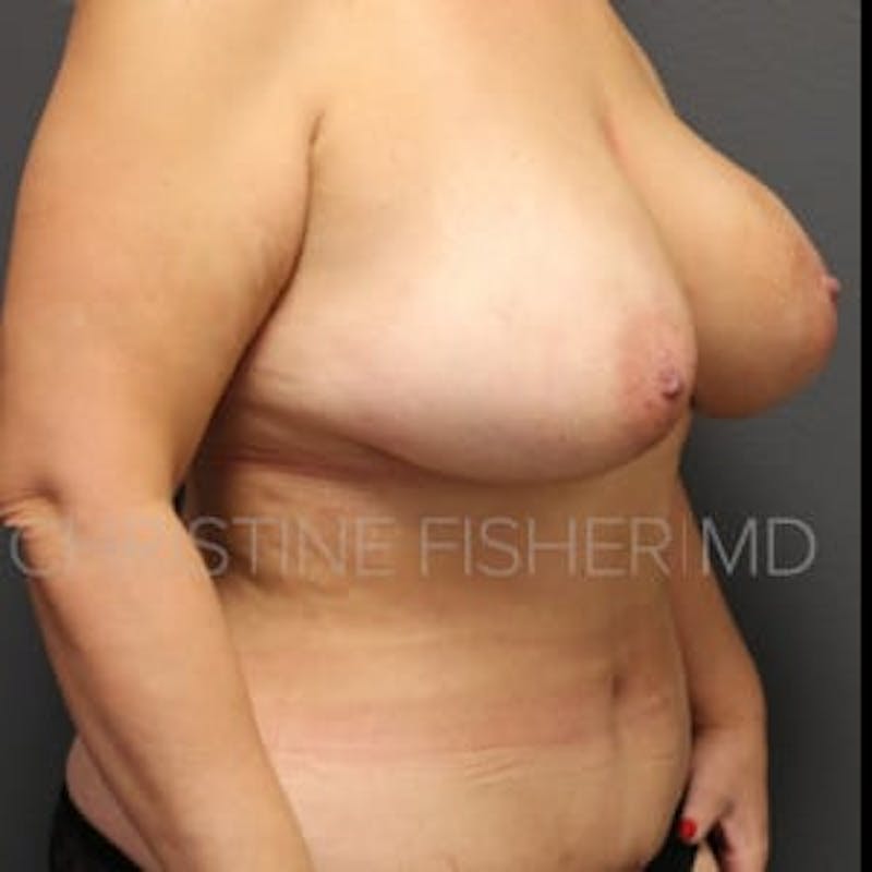 Nipple-Sparing Breast Reconstruction Before & After Gallery - Patient 239685 - Image 6