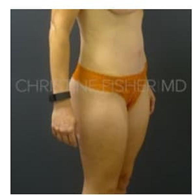 Abdominoplasty / Tummy Tuck Before & After Gallery - Patient 114021 - Image 6
