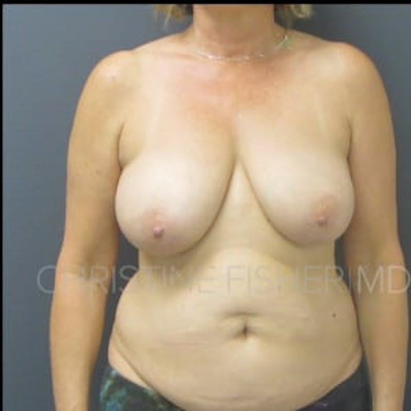 DIEP Flap Before & After Gallery - Patient 171872 - Image 1
