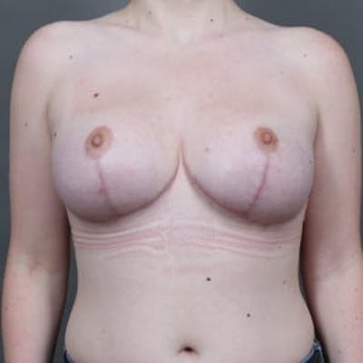 Breast Lift Before & After Gallery - Patient 374446 - Image 2