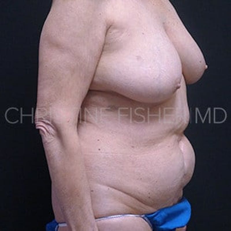 Areola Tattooing Before & After Gallery - Patient 172364 - Image 5