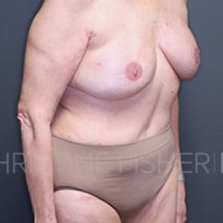 Areola Tattooing Before & After Gallery - Patient 172364 - Image 6