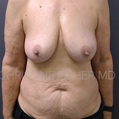Areola Tattooing Before & After Gallery - Patient 186152 - Image 1