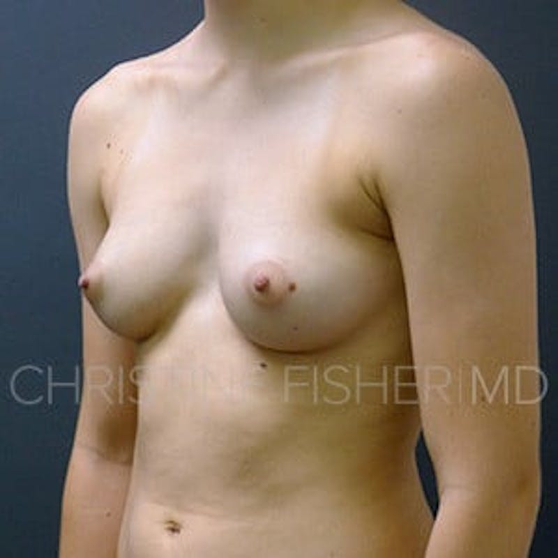 Implant Breast Reconstruction Before & After Gallery - Patient 234475 - Image 3