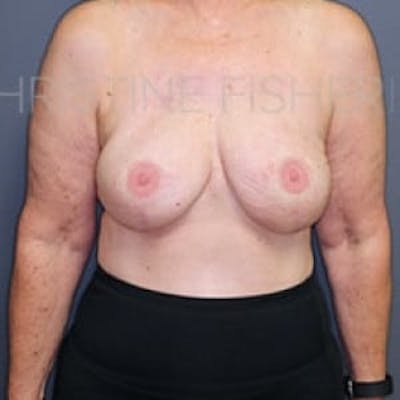 Areola Tattooing Before & After Gallery - Patient 186152 - Image 2